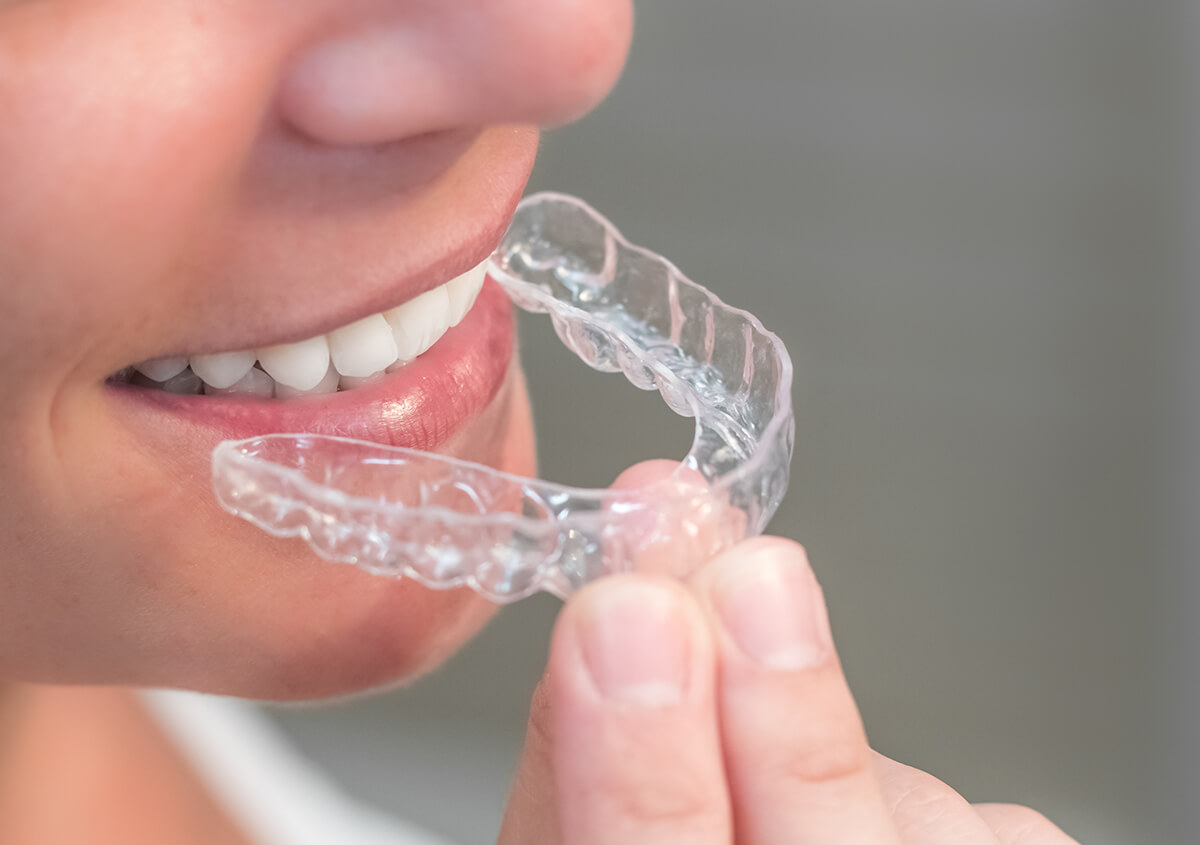 Know More About Invisible Braces / Clear Teeth Aligners Treatment